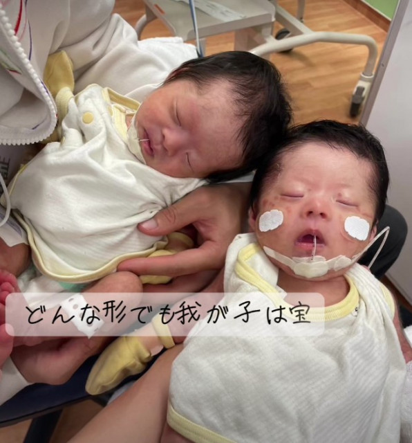 小さな体で様々な治療を乗り越えている双子ちゃん