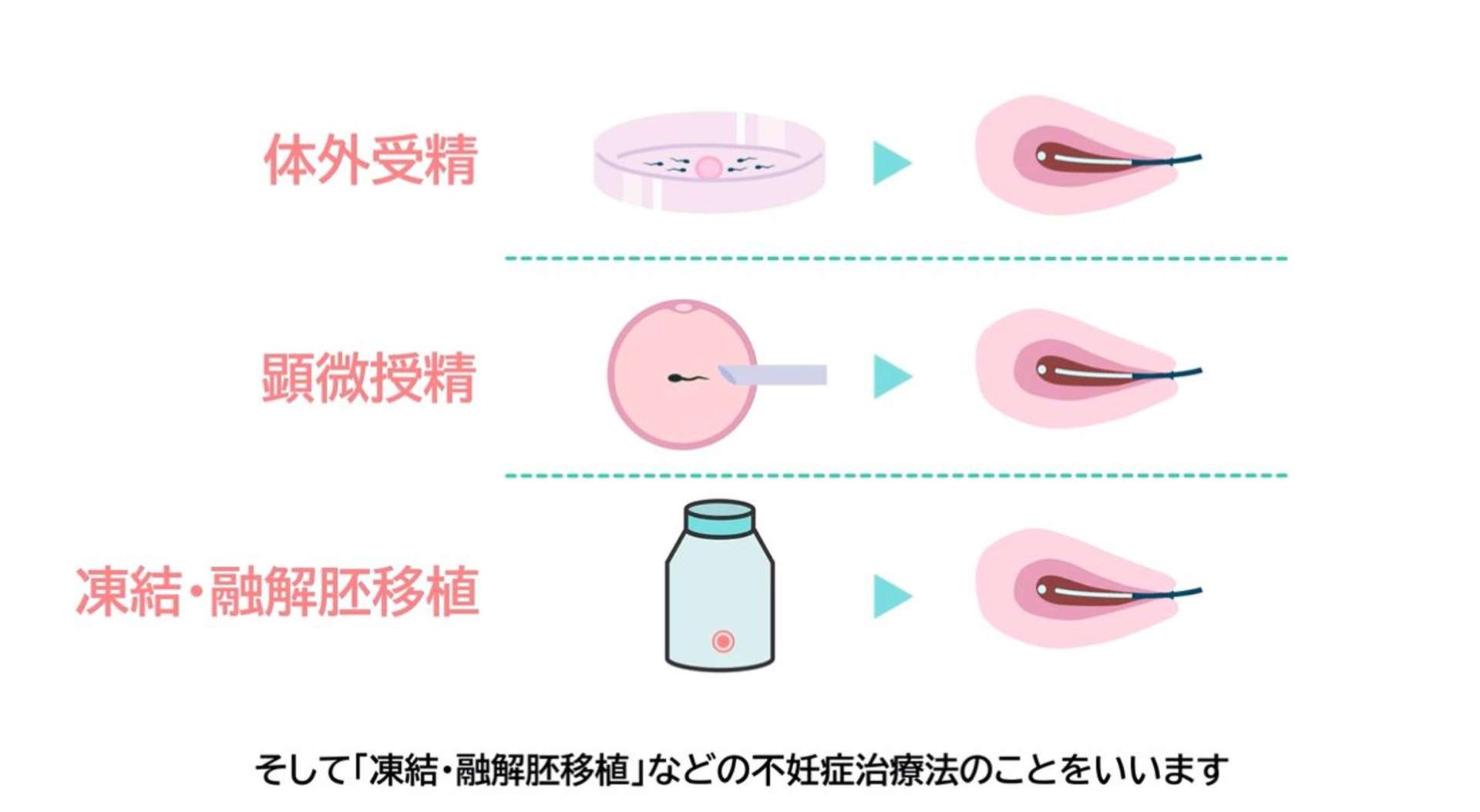 不妊治療の種類について説明する動画の一こま（竹内レディースクリニック提供）