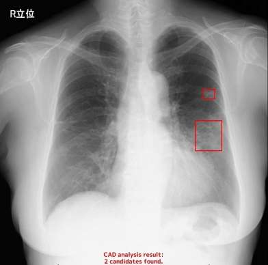 ＡＩが胸部エックス線検査の画像を分析するイメージ。肺がんが疑われる部分が赤い四角で囲まれている（エルピクセル提供）