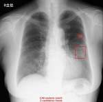 ＡＩが胸部エックス線検査の画像を分析するイメージ。肺がんが疑われる部分が赤い四角で囲まれている（エルピクセル提供）